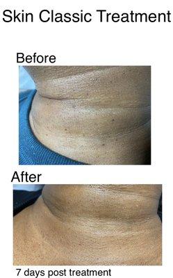 Skin classic treatment. DPN removal.