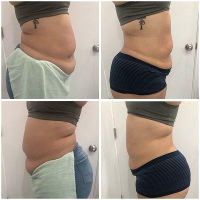 Waisted Body Contouring