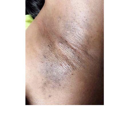 Underarms after