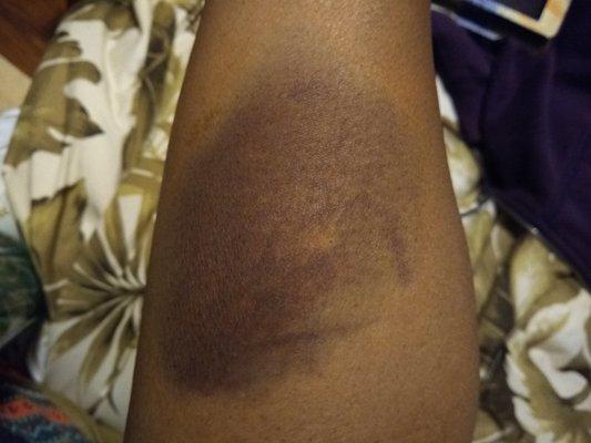 I ask the nurse if she knew how to give an I-V. She said Yes, I do it 5 times a day.
This is my arm after her unsuccessful try.
