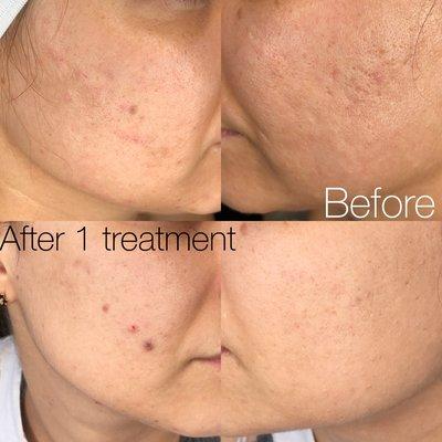 Microchanneling with Growth Factor 1 session. 2 months post treatment.