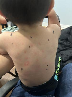 Allergy testing