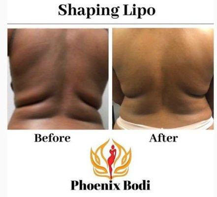 Shaping Lipo knocks out back rolls!