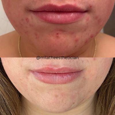 Acne bootcamp graduate now working on scar revision and PIE (post inflammatory erythema)