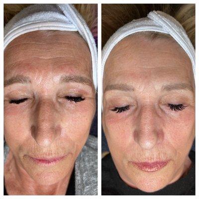 Results of two Procell microchanneling treatments.