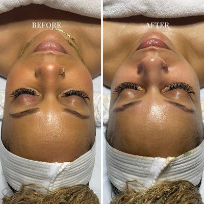 Custom Design Facial Before + After