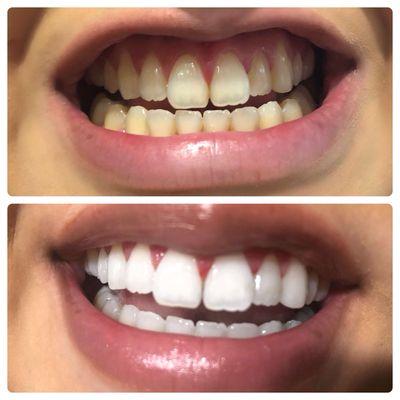 Before & After Whitening