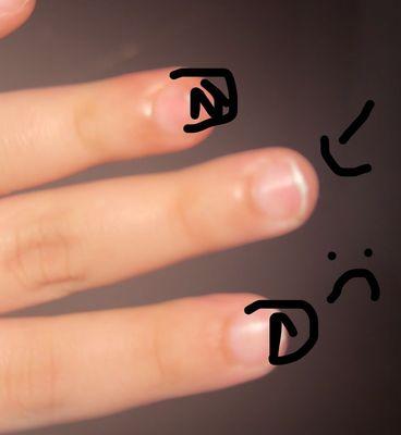 Picture of my finger that got no infection