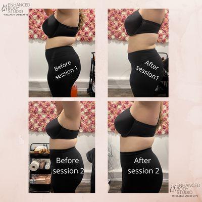 Combination of Wood Therapy and Cavitation