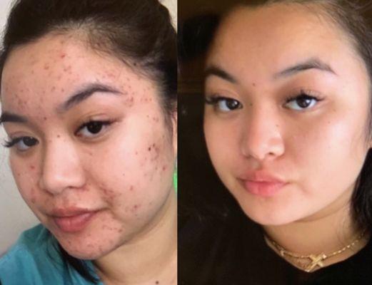 Clear skin takes time and patience. Proper treatments and products can help in improving the quality of your skin!