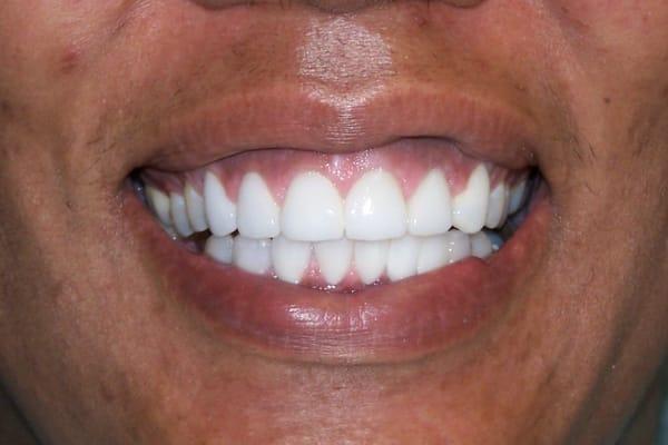 Crowns and Bridges-After