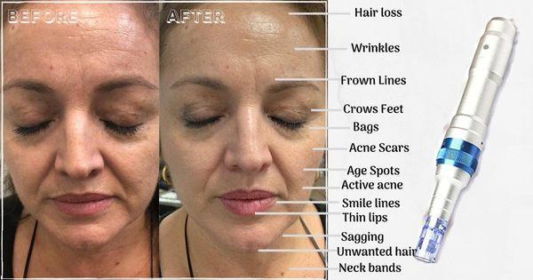 Microneedle system or DERMA pen treatment