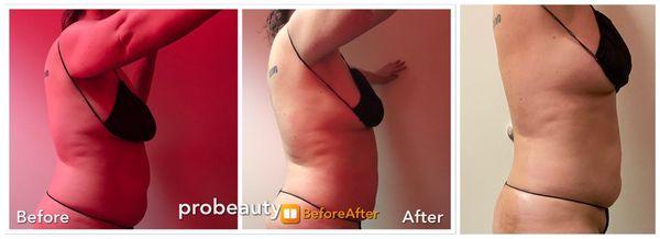 Fat reduction treatment. Progress in 3 20 minute treatments !