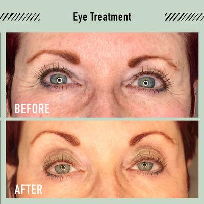 PlasmaLift Skin Clinic