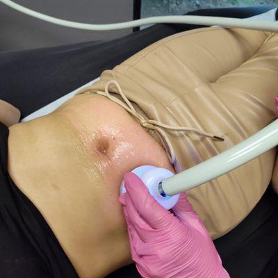 T-Shock Cryo Cellulite Treatment