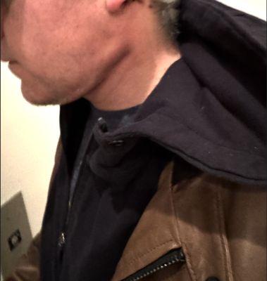 side profile post-op