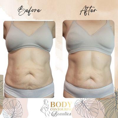 Do you have some extra fat and lise skin? Services include Ultrasonic Cavitation
Wood therapy and radio frequency skin tightening.
