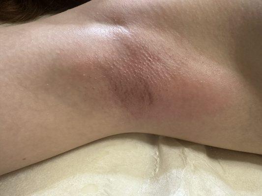 After underarm sugar wax