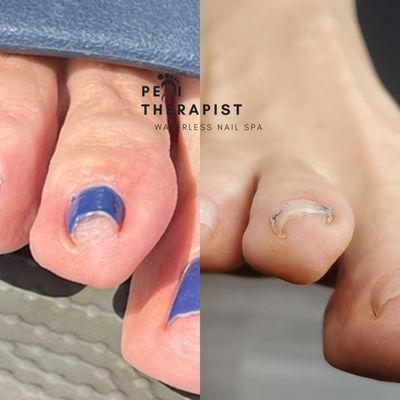 Toenail Correction Pedicure
