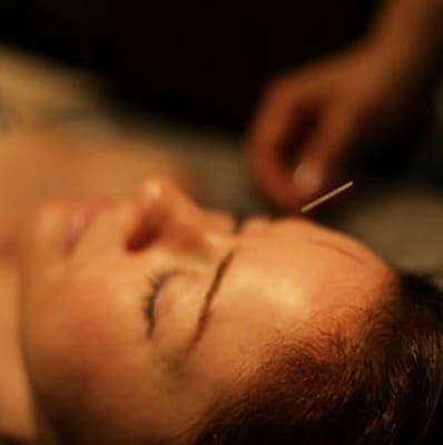 Zen acupuncture