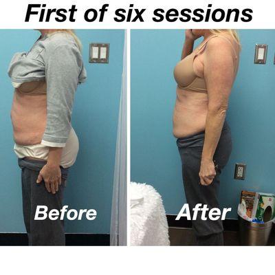 First session of Non-invasive Laser-Lipo and Skin Tightening.