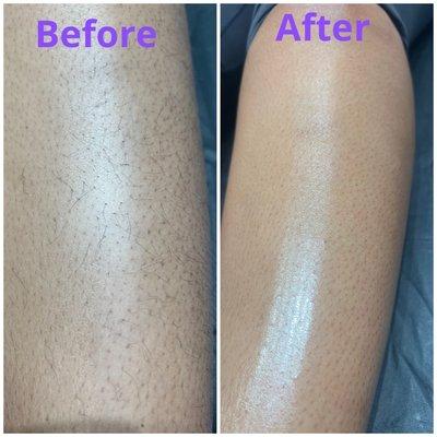 Results of leg sugaring