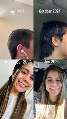 Hair transformation using K-tips after brain surgery where I had to have had half my head shaved