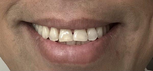 After Fill by Dr. Ding