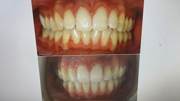 Teeth before and after