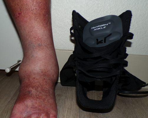 Inline Prosthetic Orthotic Systems