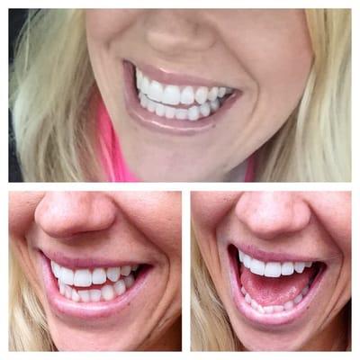 Before on the lower and after on top! Couldn't be happier with my straight lower teeth!