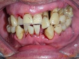 horrible teeth from the dentist