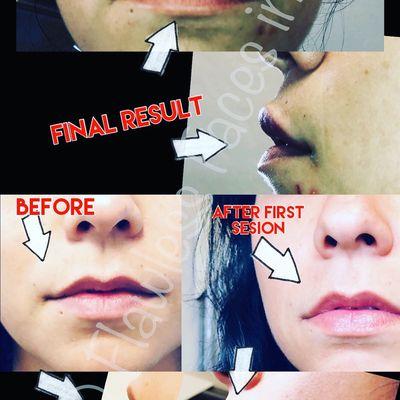 Lip Filler
