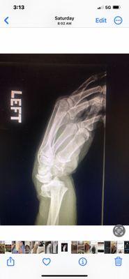 Complete crush of radius and two fractures of ulnar. Complete displacement of hand.