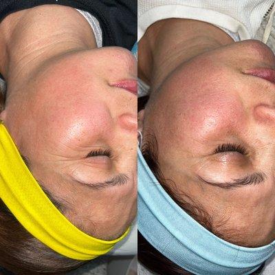 Microneedling