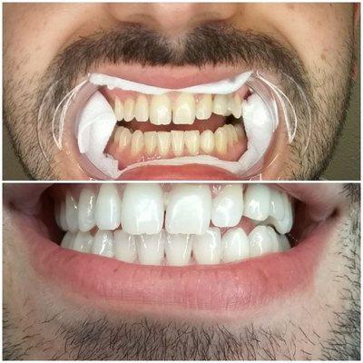 Theslatellc 30min whitening boost before and after