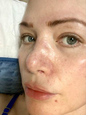 Bulbous and indent on the side even after he put filler in it as well as permanent red scarring