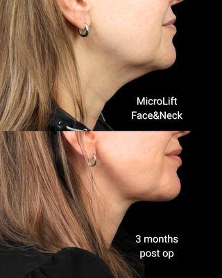 Dr. Philip Miller - #1 Facelift and Rhinoplasty Surgeon in New York