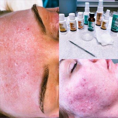 Perfect frosting after a Salicylic acid peel. This peel is used to clear acne, fade acne scars and resurface the skin.