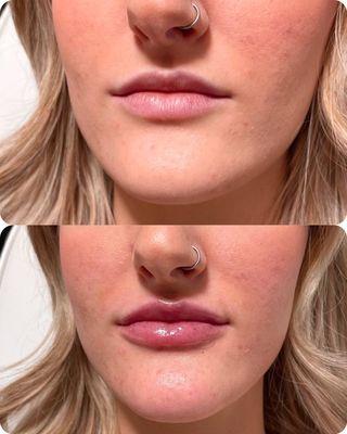 Lip Filler