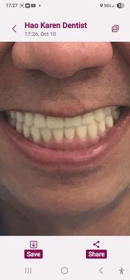 My beautiful teeth today October 25.