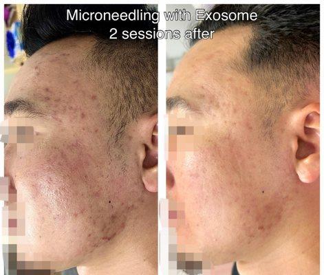 Microneedling
