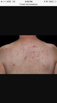 Waxed my whole back didn't even tell me how much and now I'm breaking out and they won't even admit to their nasty practice of clean wax.