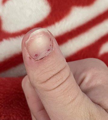 Cut on my cuticle while filing