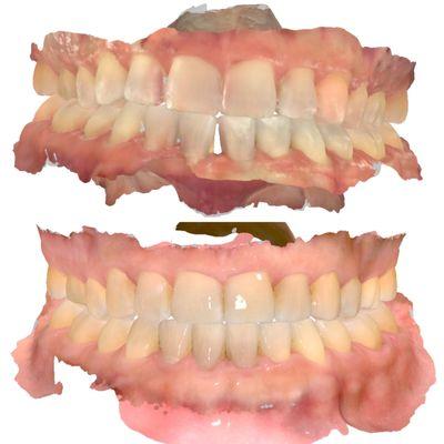 Invisalign is a conservative way to improve a smile.