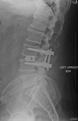 The cage and screws installed for spine support.