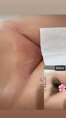 Brazilian- Sugar waxing