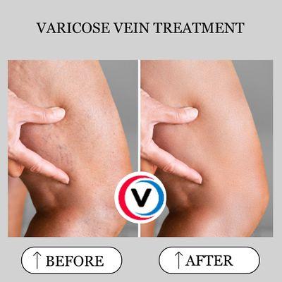 Vital Vein And Vascular - Placentia