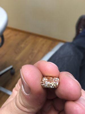 Custom gold tooth Dr. Fligor did when I needed to get a bad tooth replaced