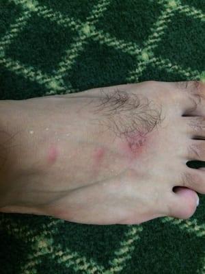 Bed bug bite 01/17/2014 room 208